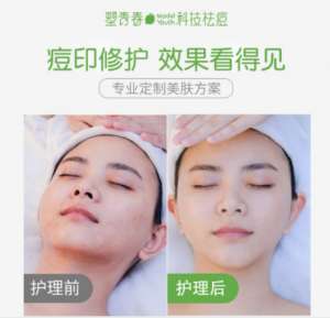闭合性痘痘如何去除好的快